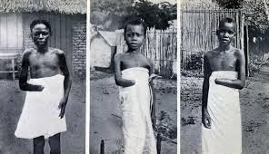 Dismembered children hands in the Congo